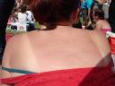 My lovely sunburnt back